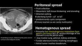 Peritoneal spread
• Fluid collection
• Mesenteric Soft tissue thickening and stranding
• Omental cacking
Krukenberg tumor : u/l or b/l
• predominantly cystic component
(Primary ovarian ca are rarely multicystic)
Hematogenous spread
• Primarily liver Haematogenous metastases from
gastric carcinoma (b/c of venous drainage of the
stomach is via the portal vein)
• may involve Lung ,adrenal, kidney and brain.
• Fundal adenocarcinoma involving oesophagus
• Antral tumor involves duodenum.
Krukenberg tumours. Bilateral partly cystic ovarian
tumours and malignant ascites.
 