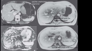, T2-weighted MRI shows a mass (M) with
intermediate signal intensity.
Mass along lesser curva.
Poor contrast enha. On
early arterial phase
isointensity to that of the liver in the delayed phase (D).
GASTRIC LYMPHOMA
:segmental
 