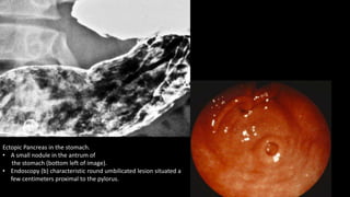 Ectopic Pancreas in the stomach.
• A small nodule in the antrum of
the stomach (bottom left of image).
• Endoscopy (b) characteristic round umbilicated lesion situated a
few centimeters proximal to the pylorus.
 