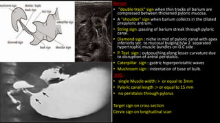 Barium
• "double track" sign when thin tracks of barium are
compressed between thickened pyloric mucosa.
• A "shoulder" sign when barium collects in the dilated
prepyloric antrum.
• String sign :passing of barium streak through pyloric
canal.
• Diamond sign : niche in mid of pyloric canal with apex
inferiorly sec. to mucosal bulging b/w 2 separated
hypertrophic muscle bundles on G.C side .
• P. Teat sign : outpouching along lesser curvature due
to disruption of antral peristalsis.
• Caterpillar sign : gastric hyperperistaltic waves
• Mushroom sign : indentation of base of bulb.
USG :
• single Muscle width: > or equal to 3mm
• Pyloric canal length :> or equal to 15 mm
• no peristalsis through pylorus
Target sign on cross section
Cervix sign on longitudinal scan
 