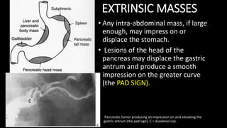 EXTRINSIC MASSES
• Any intra-abdominal mass, if large
enough, may impress on or
displace the stomach.
• Lesions of the head of the
pancreas may displace the gastric
antrum and produce a smooth
impression on the greater curve
(the PAD SIGN).
Pancreatic tumor producing an impression on and elevating the
gastric antrum (the pad sign). C = duodenal cap.
 