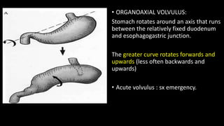 • ORGANOAXIAL VOLVULUS:
Stomach rotates around an axis that runs
between the relatively fixed duodenum
and esophagogastric junction.
The greater curve rotates forwards and
upwards (less often backwards and
upwards)
• Acute volvulus : sx emergency.
 