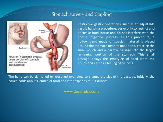 stapled stomach surgery cost