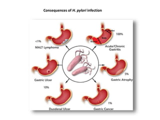 Consequences of H. pylori infection
 
