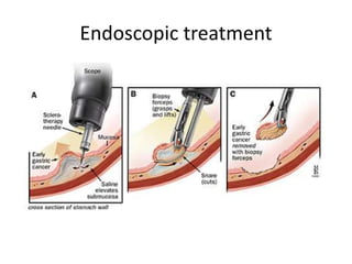 Endoscopic treatment
 