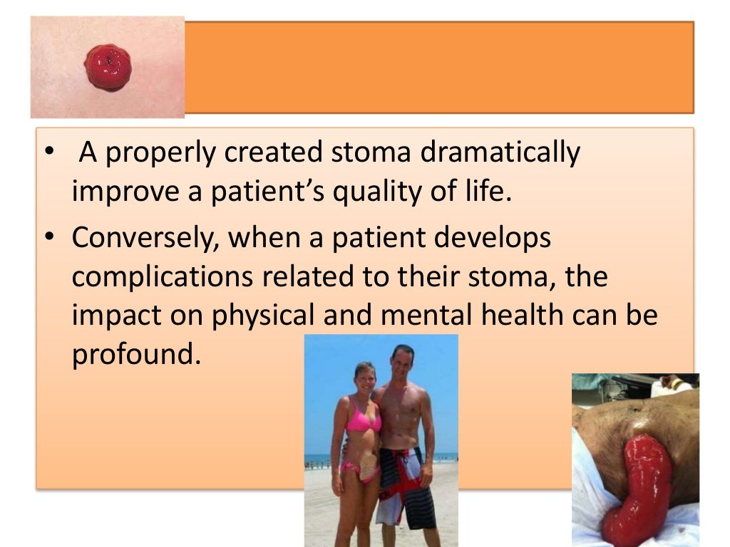 Stoma complications by Prof. Ajay Khanna, IMS, BHU, Varanasi India