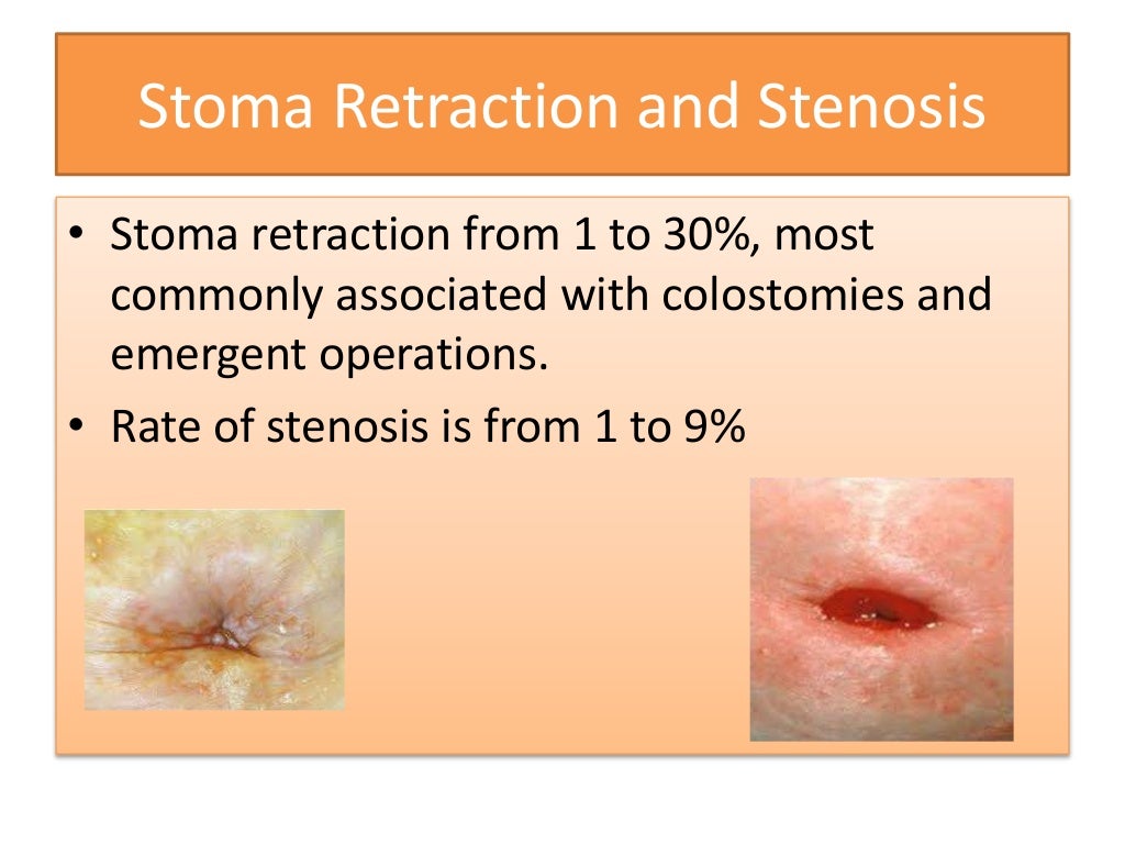 Stoma complications by Prof. Ajay Khanna, IMS, BHU, Varanasi India