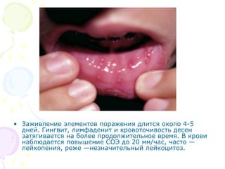 • Заживление элементов поражения длится около 4-5 
дней. Гингвит, лимфаденит и кровоточивость десен 
затягивается на более продолжительное время. В крови 
наблюдается повышение СОЭ до 20 мм/час, часто — 
лейкопения, реже —незначительный лейкоцитоз. 
 