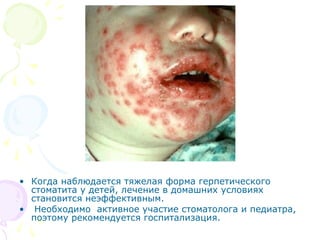 • Когда наблюдается тяжелая форма герпетического 
стоматита у детей, лечение в домашних условиях 
становится неэффективным. 
• Необходимо активное участие стоматолога и педиатра, 
поэтому рекомендуется госпитализация. 
 