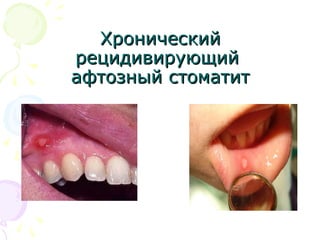 ХХррооннииччеессккиийй 
ррееццииддииввииррууюющщиийй 
ааффттооззнныыйй ссттооммааттиитт 
 