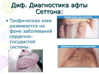 ДДиифф.. ДДииааггннооссттииккаа ааффттыы 
ССееттттооннаа:: 
• Трофическая язва 
развивается на 
фоне заболеваний 
сердечно- 
сосудистой 
системы. 
 