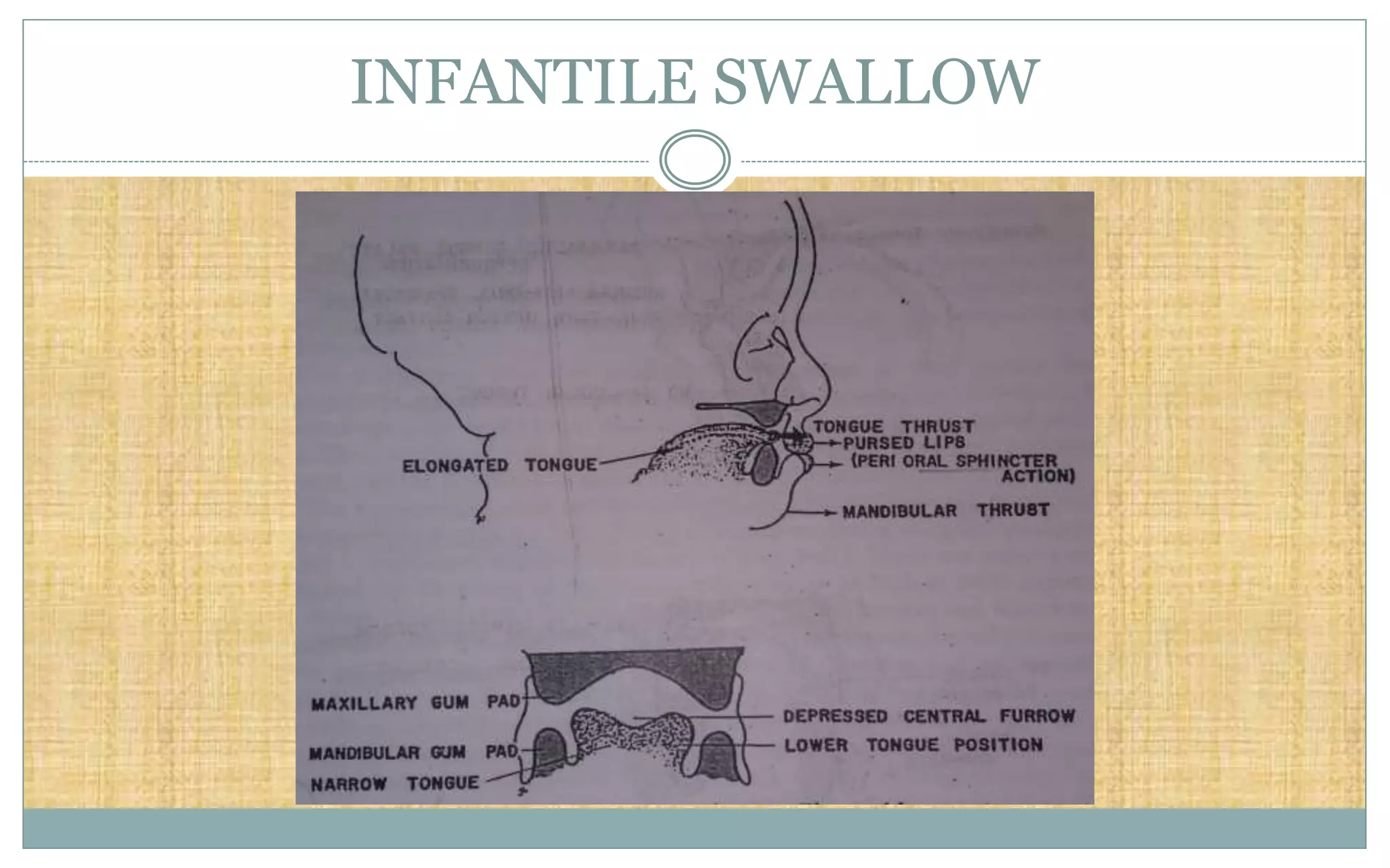 INFANTILE SWALLOW
 