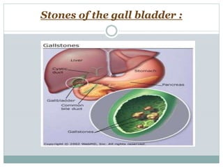 Stones of the gall bladder :
 