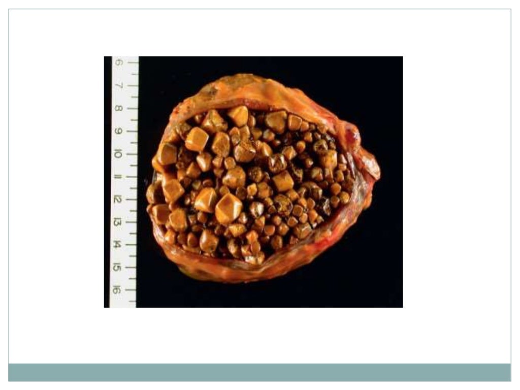 Stones of the gall bladder