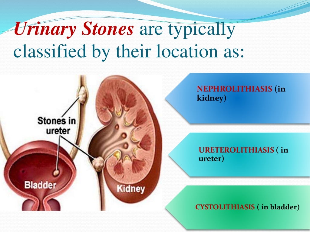 presentation on kidney stones