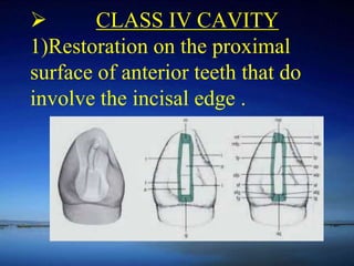 Principles of cavity preparation by Dr .rupali | PPT