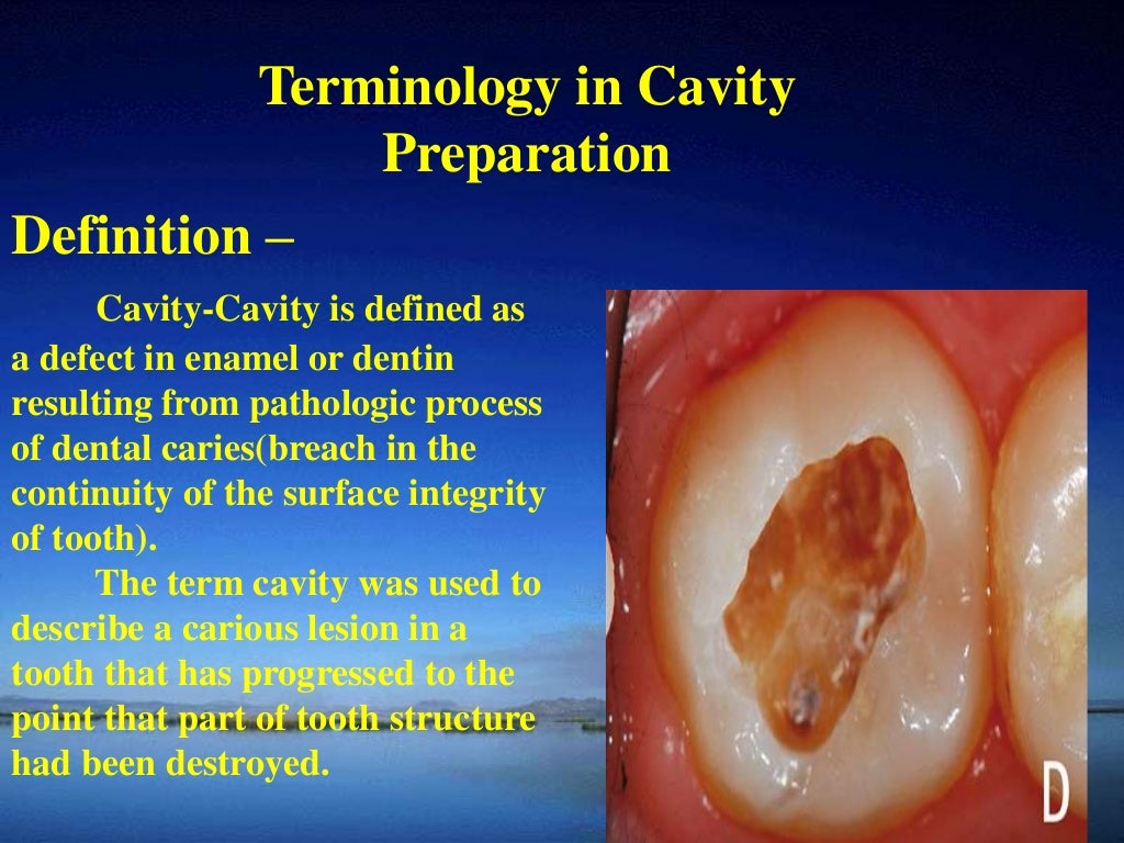 Principles of cavity preparation by Dr .rupali