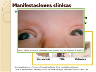 Manifestaciones clínicasManifestaciones clínicas
Su aspecto clínico más relevante es la
infección transplacentaria y la afectación
fetal que forma parte del síndrome de
rubéola congénita (SRC).
Neonatología, Diagnostico y Tratamiento, Primera edición, Capitulo X, Enfermedades Infecciosas, Rubeola,
Tratado de Pediatría de Nelson, 18va edición, volumen II, Sección 8, PARTE XVI , Enfermedades infecciosas, Rubeola,1337.
 
