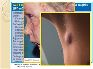 Tratado de Pediatría de Nelson, 18va edición, volumen II, Sección 8, PARTE XVI , Enfermedades
infecciosas, Rubeola.
 