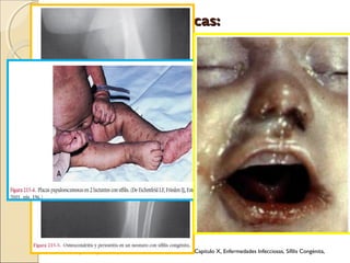 Manifestaciones clínicas:Manifestaciones clínicas:
Neonatología, Diagnostico y Tratamiento, Primera edición, Capitulo X, Enfermedades Infecciosas, Sífilis Congénita,
 