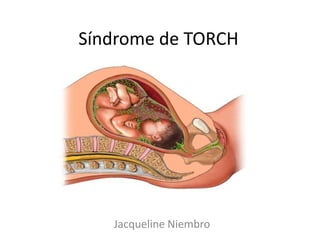 Síndrome de TORCH




   Jacqueline Niembro
 