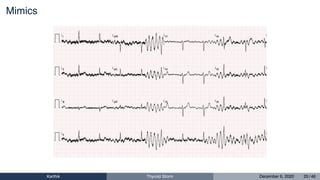 Mimics
Karthik Thyroid Storm December 6, 2020 25 / 46
 