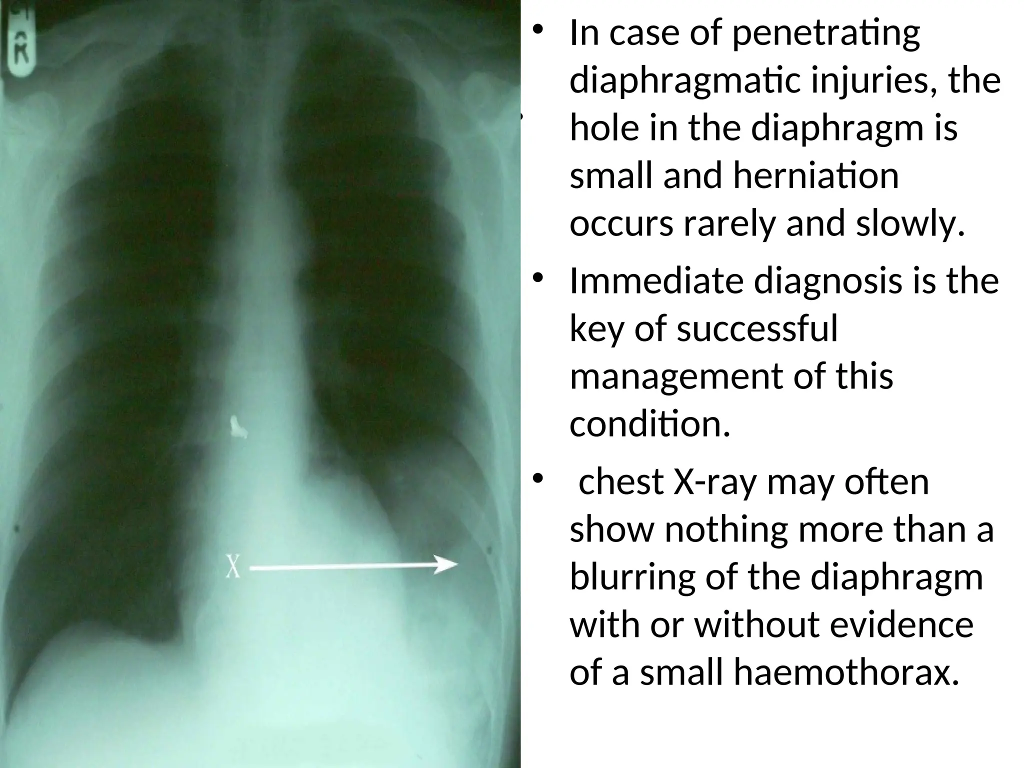 STOVE IN CHEST, FLAIL CHEST AND TRAUMATIC RUPTURE OF DIAPHRAGM.ppt