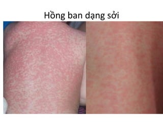 Hồng ban dạng sởi
 