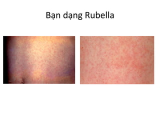 Bạn dạng Rubella
 