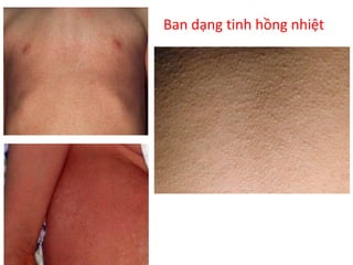 Ban dạng tinh hồng nhiệt
 