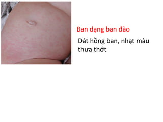 Ban dạng ban đào
Dát hồng ban, nhạt màu
thưa thớt
 