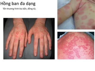 Hồng ban đa dạng
Tổn thương hình bia bắn, đồng tử,
 