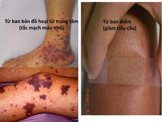 Tử ban điểm
(giảm tiểu cầu)
Tử ban bản đồ hoại tử trung tâm
(tắc mạch máu nhỏ)
 