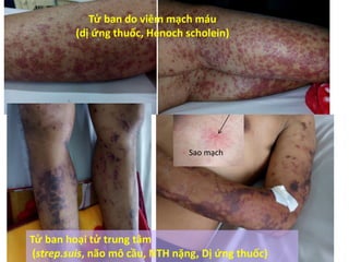 Tử ban do viêm mạch máu
(dị ứng thuốc, Henoch scholein)
Tử ban hoại tử trung tâm
(strep.suis, não mô cầu, NTH nặng, Dị ứng thuốc)
Sao mạch
 