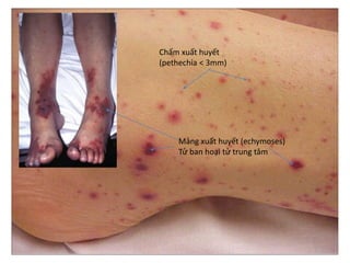 Chấm xuất huyết
(pethechia < 3mm)
Mảng xuất huyết (echymoses)
Tử ban hoại tử trung tâm
 