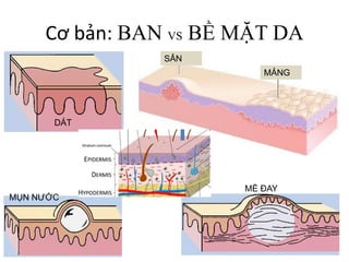 Cơ bản: BAN VS BỀ MẶT DA
DÁT
SẨN
MẢNG
MỤN NƯỚC
MỀ ĐAY
 