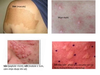 Dát (macule)
Sẩn (paplule <1cm), nốt (nodule ≥ 1cm,
cảm nhận được khi sờ)
Mề đay (sẩn phù): (phù viêm phần trên của
lớp bì, thượng bị không bị ảnh hưởng)
Mụn nước
 