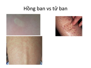 Hồng ban vs tử ban
 