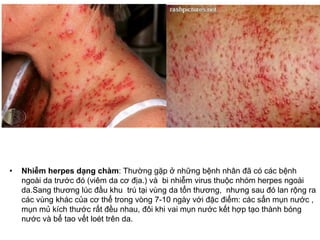 • Nhiễm herpes dạng chàm: Thường gặp ở những bệnh nhân đã có các bệnh
ngoài da trước đó (viêm da cơ địa.) và bi nhiễm virus thuộc nhóm herpes ngoài
da.Sang thương lúc đầu khu trú tại vùng da tổn thương, nhưng sau đó lan rộng ra
các vùng khác của cơ thể trong vòng 7-10 ngày với đặc điểm: các sẩn mụn nước ,
mụn mủ kích thước rất đều nhau, đôi khi vai mụn nước kết hợp tạo thành bóng
nước và bể tao vết loét trên da.
 