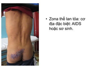 • Zona thể lan tỏa: cơ
địa đặc biệt: AIDS
hoặc sơ sinh.
 