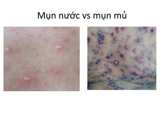 Mụn nước vs mụn mủ
 