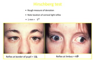 Hirschberg Test Normal Strabismus | PPSX