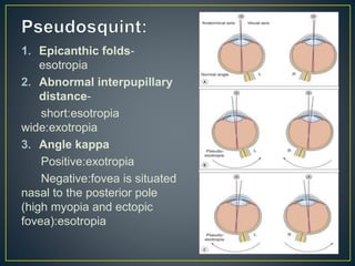 1. Epicanthic folds-
esotropia
2. Abnormal interpupillary
distance-
short:esotropia
wide:exotropia
3. Angle kappa
Positive:exotropia
Negative:fovea is situated
nasal to the posterior pole
(high myopia and ectopic
fovea):esotropia
 