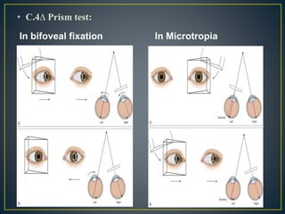 • C.4∆ Prism test:
In bifoveal fixation In Microtropia
 