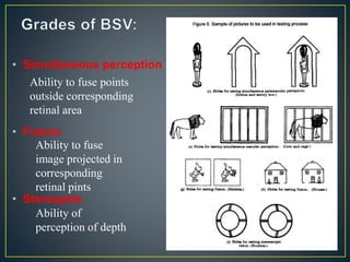 • Simultaneous perception
• Fusion
• Stereopsis
Ability to fuse points
outside corresponding
retinal area
Ability to fuse
image projected in
corresponding
retinal pints
Ability of
perception of depth
 