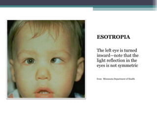 ESOTROPIA
The left eye is turned
inward—note that the
light reflection in the
eyes is not symmetric
from: Minnesota Department of Health
 