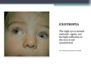 EXOTROPIA
The right eye is turned
outward—again, not
the light reflection in
the eyes is not
symmetrical
from: Minnesota Department of Health
 
