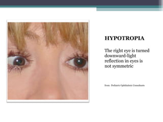 HYPOTROPIA
The right eye is turned
downward-light
reflection in eyes is
not symmetric
from: Pediatric Ophthalmic Consultants
 