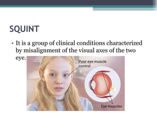 SQUINT
• It is a group of clinical conditions characterized
by misalignment of the visual axes of the two
eye.
 