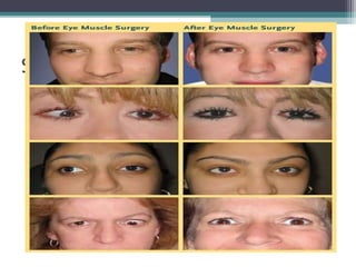Surgeries
The surgeries for the weakening of the muscle are,
• Recession
• Myotomy
• Tenotomy
Surgeries for strengthening the muscle are,
• Resection
• Tucking
• Transposition
 